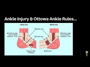 Ottawa Ankle Rules