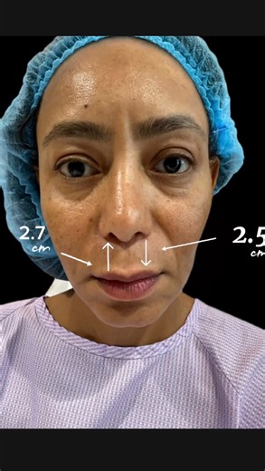 ‎دكتور معن الخطيب‎ on Instagram‎: "✨ جراحة رفع الشفة تمنح توازناً مثالياً للوجه وتبرز جمال الابتسامة بطريقة طبيعية ودائمة. دقة جراحية لملامح أكثر شباباً وأناقة. 💉🌿 ✨ Lip lift surgery enhances facial harmony and highlights your smile with natural, long-lasting results. Surgical precision for a more youthful and elegant look. 💉🌿 #foryou #fyp #اكسبلور_explore #maxfax #dxb"‎