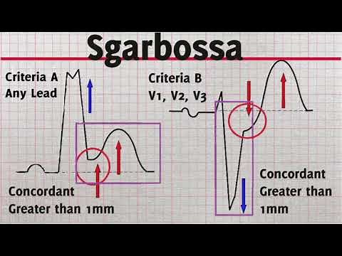 Current ECG Ep 4 Sgarbossa Criteria STEMI LBBB