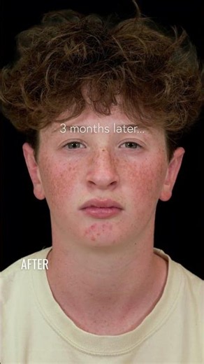 Otoplasty Ear Pinning for Teens: The Best Gift Ever Is Confidence | San Diego