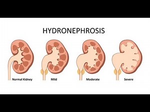Hydronephrosis (Swelling of kidney) ; Definition, Causes, Symptoms, Diagnosis, Treatment