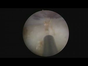 Laser Bladder Neck Incision BNI