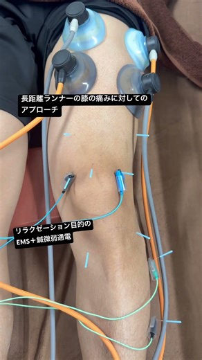 長距離ランナーの膝の痛みに対してのアプローチ（EMS＋鍼微弱通電）