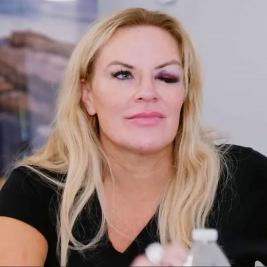 RHOSLC's Heather Gay Shares New Insight Into What Caused Her Mysterious Black Eye