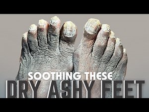Trimming Fungal Toenails