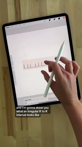 Kristine Tuttle on Instagram: "– EKG Interpretation – EKG strips can seem intimidating at first. Take the interpretation process STEP BY STEP Identify the P-wave, recognize if one is not present Identify the PR interval Identify the QRS complex & measure Identify the R-R interval Assess if the intervals are regular or irregular Determine the rate Some arrhythmias are a little easier to identify than others, so learning about each one, how they will present, and how the intervals and segments wil