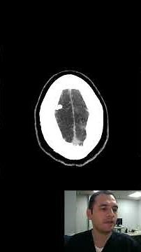 EARLY ISCHEMIC STROKE #radiology #stroke #ctscan #medicine