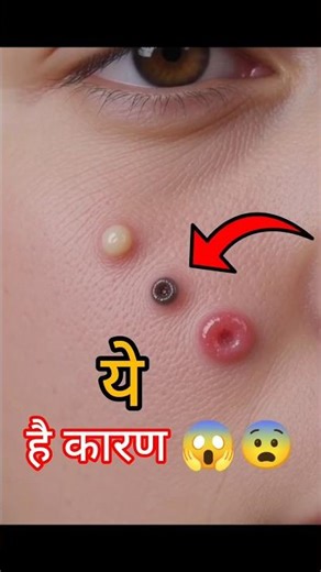 पिंपल्स क्यों होते है 😱 #shorts #youtubeshorts #pimple #causes #healthtips #nurse#nursing #medical