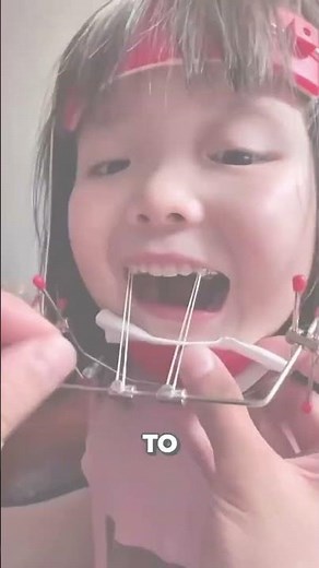 This Headgear Looks Terrifying But Actually Works #braces #orthodontist #transformation