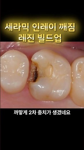 씹을 때 찌릿한 어금니? 깨진 세라믹 인레이 당일 치료법 #어금니충치 #레진빌드업 #세라믹인레이