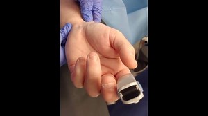 M - The radial artery: Open harvesting technique