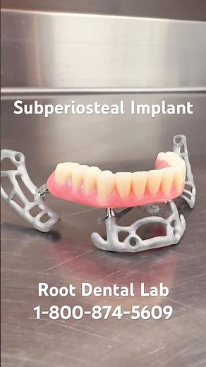 Subperiosteal Implant! #dentist #dentalrestoration #oralsurgery #implant #usamade #dentallab #teeth