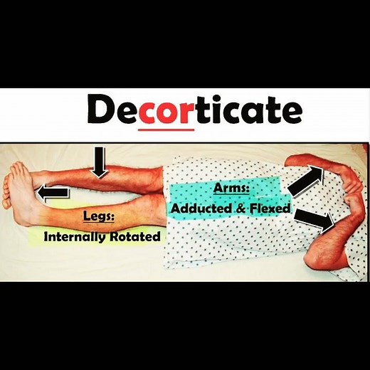 decorticate vs decerebrate posturing #medical #medicine #education #easy #educational #health