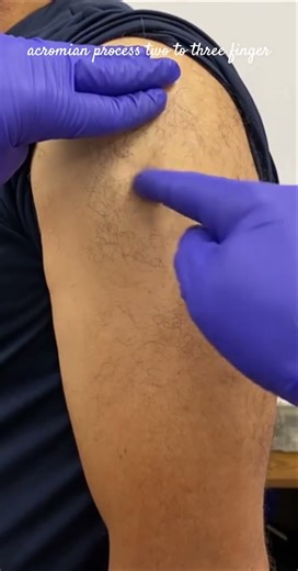 Z technique for intramuscular injection