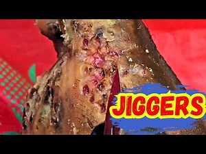 what are jiggers | jiggers parasite treatment | 100% Effective Against Jigger Parasites.