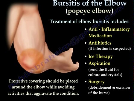 Bursitis of the Elbow— Popeye Elbow