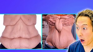 How massive weight loss can affect skin