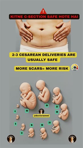How Many C-Sections Are Safe? 🤰💉 @doctorammi #babydevelopment #pregnancy #shorts #ytshorts