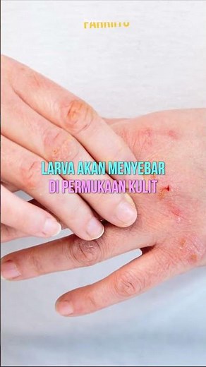 apa itu scabies
