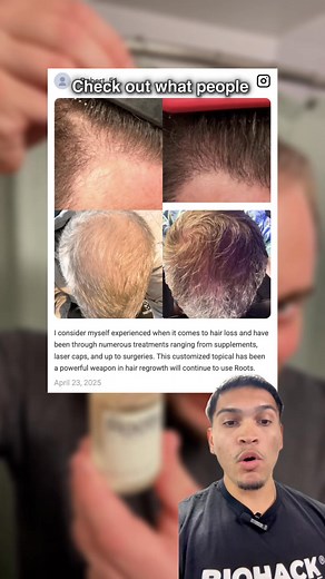 🎁 DNA test normally costs $250. Right now? FREE. Just pay $97 for your personalized hair formula. This test tells you if you're a Minoxidil non-responder, which DHT blockers work for YOUR genetics, and exactly what ingredients to use. ✅ DNA test: $0 (save $250) ✅ Custom topical: $97 ✅ Doctor-prescribed for you Limited time. No guessing. Just results. | Roots by Genetic Arts