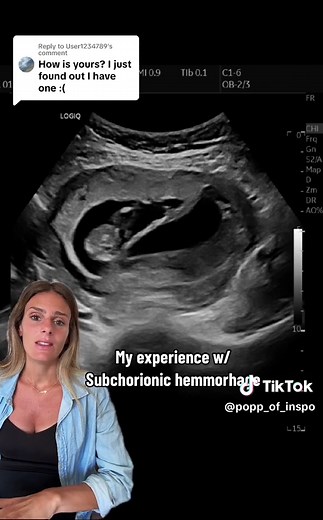 Understanding Subchorionic Hemorrhage During Pregnancy
