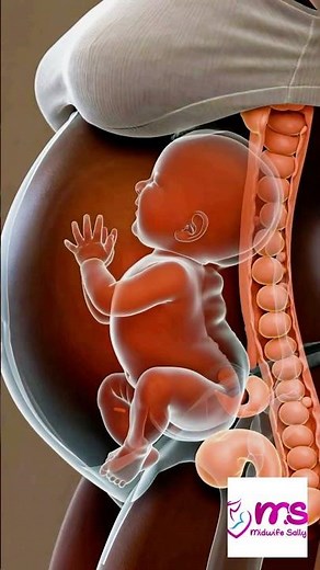 Breech presentation