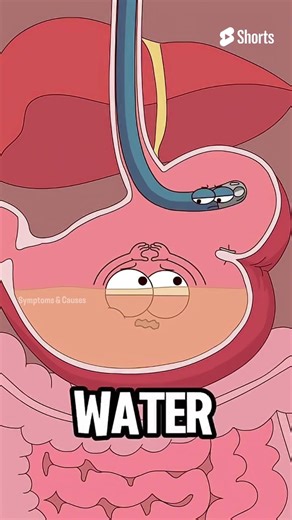 बिना surgery पेट छोटा हो सकता है? | Endoscopic Sleeve Gastroplasty | Weight Loss Secret | #shorts