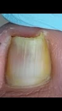 How to repair ingrown toenail