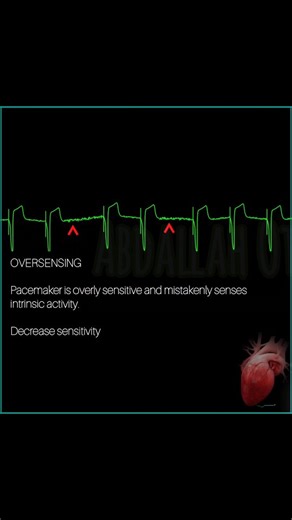 Abdallah Othman on Instagram: "Advanced Pacemaker Troubleshooting: ECG Patterns & EP Solutions⚡💡 1. Failure to Capture 2. Failure to Pace 3. Undersensing 4. Oversensing #Electrophysiology #Pacemaker #ECG #Arrhythmia"