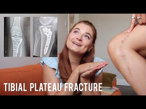 6 MONTH UPDATE - Tibial Plateau Fracture ORIF Surgery Recovery