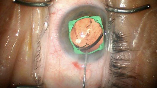 Synergy Toric IOL Implantation With Pupil Expander - Eyetube