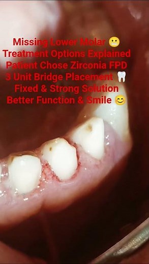 Missing Tooth Replacement 🦷 Zirconia Bridge(FPD) Treatment Explained#dentist #TheDentalGuru#shorts