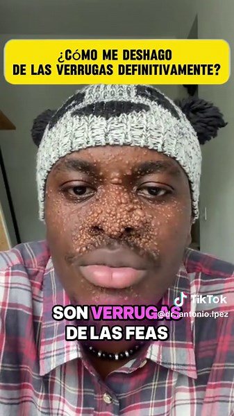 La piel no se calma, se acostumbra #verrugas #warts #wartremoval #drmitsui#hpv-xhz