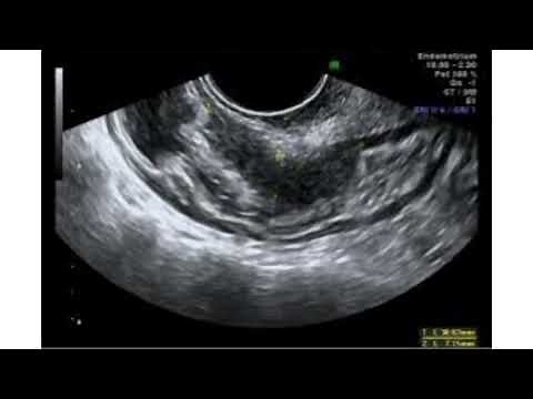 ENDOMETRIOSIS CLINICAL DATA MAIN CAUSES SYMPTOMS AND ULTRASOUND IMAGES