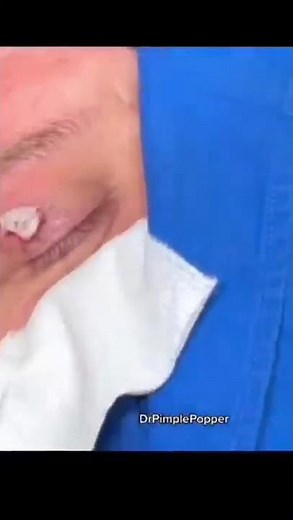Mi lee Ahhh #shorts #drpimplepopper