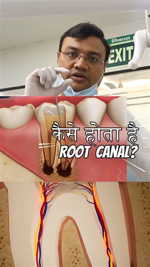 Root Canal: Modern & Almost Painless Treatment/ Dr. Kapil Gupta