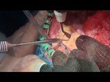 Rare Location of Facial Osteoma on the Zygomatic Arch. Hemicoronal Approach. • Video • MEDtube.net