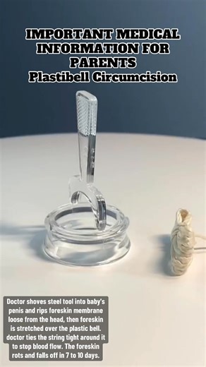 38K views · 136 reactions | Doctor shoves a steel tool into the baby's penis and rips the foreskin membrane loose from the head, then foreskin is stretched over the plastic bell, and the doctor ties the string tight to stop blood flow to the foreskin. The foreskin rots and falls off in 7 to 10 days. #circumcision | Bloodstained Men & Their Friends | Facebook