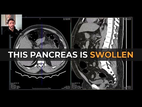 Acute Pancreatitis on CT: Every Finding You Need to Know