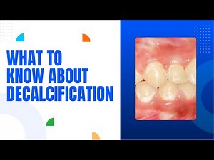 What to Know About Decalcification Dental Health 101 | Dental House MI