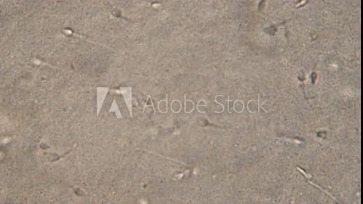 Microscopy of human sperm . Magnification 300x moving of spermatozoides in detail under microscope.