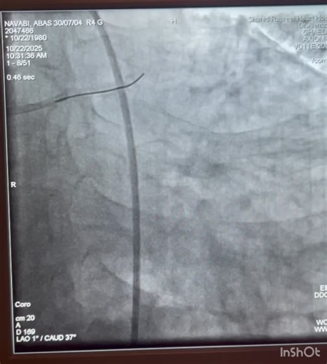 #cardiology #interventionalcardiology #bifurcationpci #octguidedpci #provisionalstrategy #coronaryintervention #cathlab #stentoptimization #medicaleducation #complexpci #teamworkinmedicine… | Amir Chegini