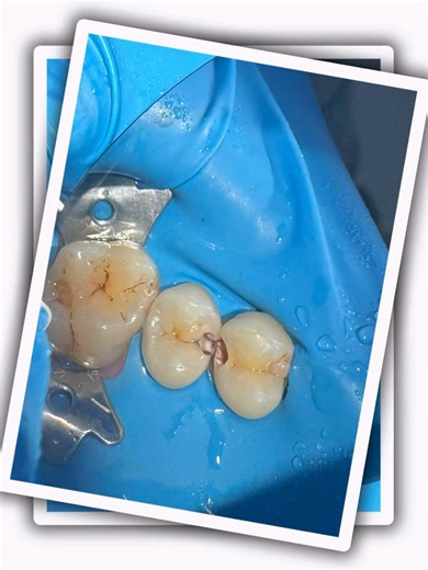 Premolar Composite Restoration🦷✨👀