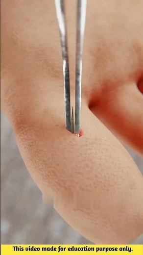 The Easiest Way to Remove a Splinter — No Tweezers Needed! 🤯