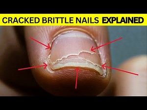 STOP Ignoring Brittle Cracked Nails! Here's What To Do