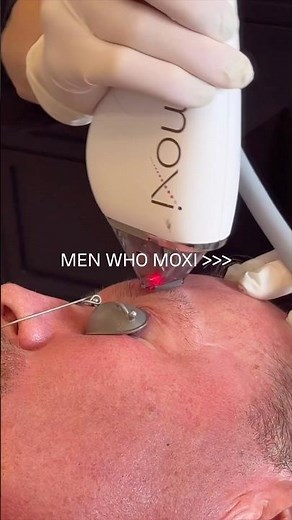 Moxi Laser Treatment for Men