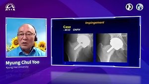 Hip Resurfacing - What Are the Facts? Minimum 20 Years Follow Up