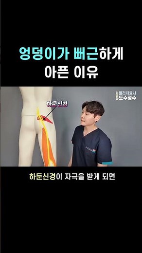 엉덩이가 뻐근하다면 확인해보세요 - 상둔피신경 자극에 의한 엉덩이 근육의 뻐근한 허혈성 통증