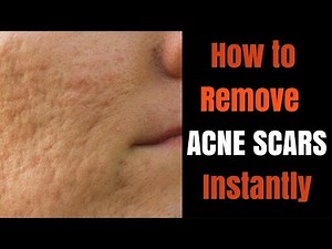 Instant acne scar removal