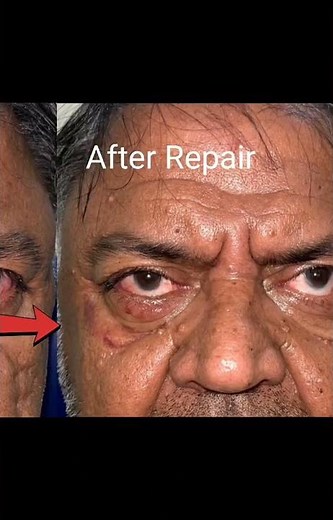 Lower eyelid ectropion (before and after surgery)